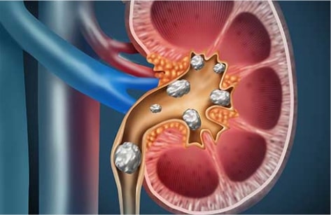 Kidney Stone Diseases